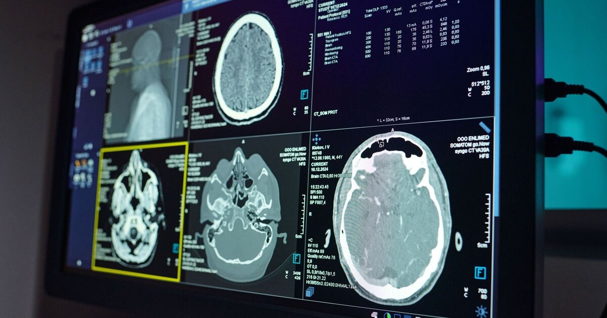 Un estudio sobre el Alzheimer hace un hallazgo sorprendente sobre las personas más sociables
