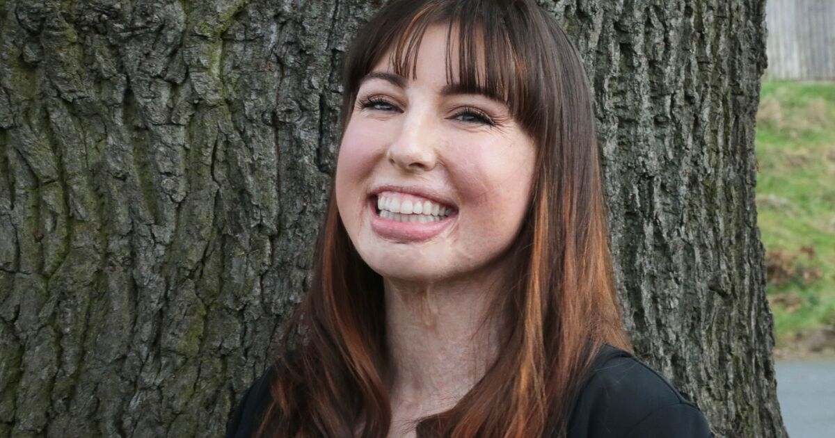 Britain's most badly burned woman feels lucky to be alive and helping patients like her