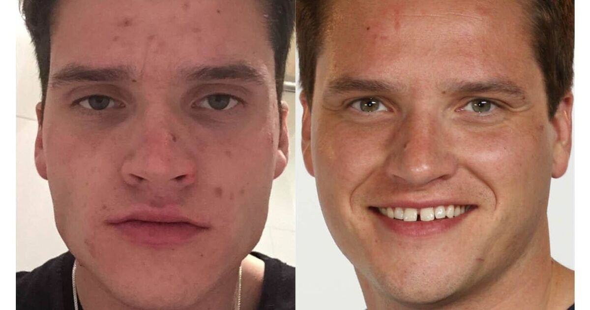 'My nan cured my acne in four days with a surprise cream'