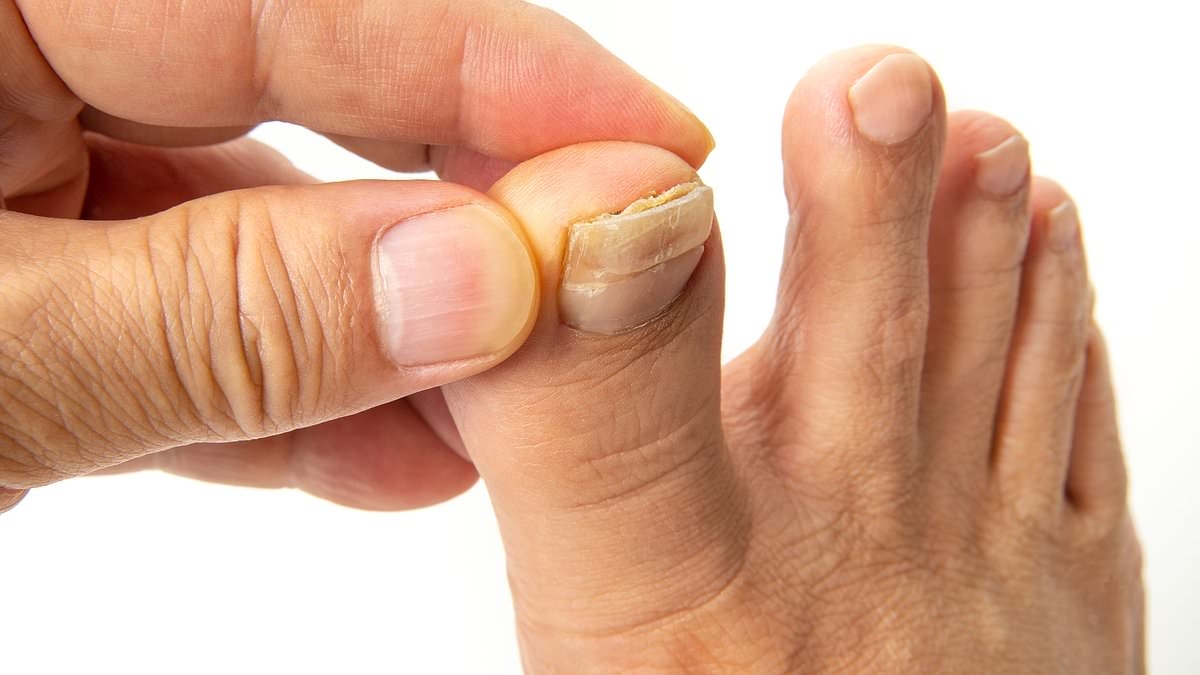 É EXATAMENTE assim que você pode consertar suas unhas dos pés com crostas, amareladas e grossas - e como saber se elas são um sinal de algo mais sinistro, pelo podólogo da Harley Street, STEVEN THOMAS
