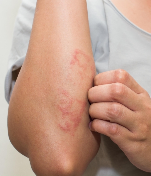 AI zal nauwkeurigere diagnoses van dermatitis opleveren