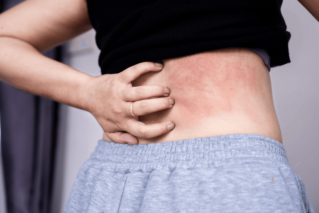 Quali sono i trattamenti migliori per l'orticaria cronica?