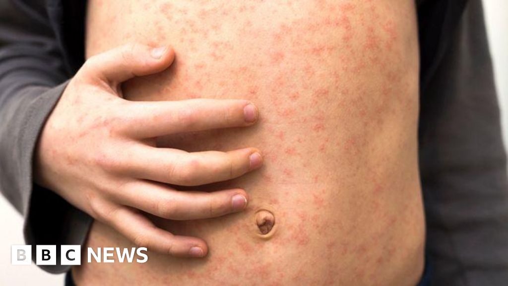 Measles holiday warning as cases rise in Europe