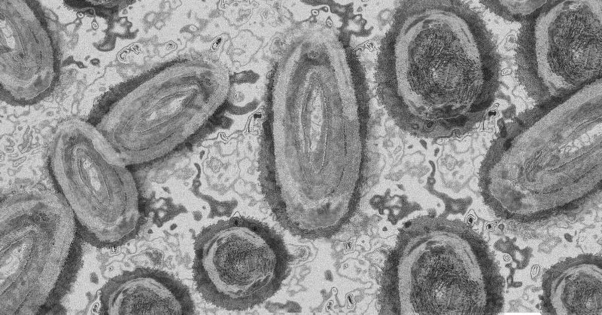 34 cas de variole détectés au Ghana