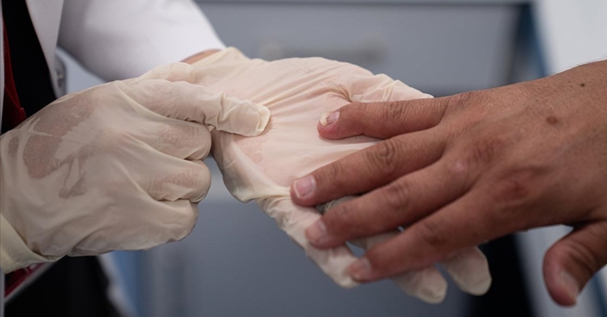 El diagnóstico precoz de la artritis psoriásica previene el daño articular