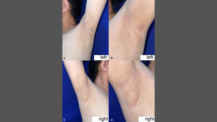 Filipińska kobieta ma wyciek mleka spod pachy. Co jest przyczyną tej rzadkiej przypadłości?