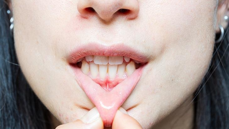 Si las encías retroceden, ¡los huesos también se derriten! Experto explicó: La causa son los cálculos dentales.