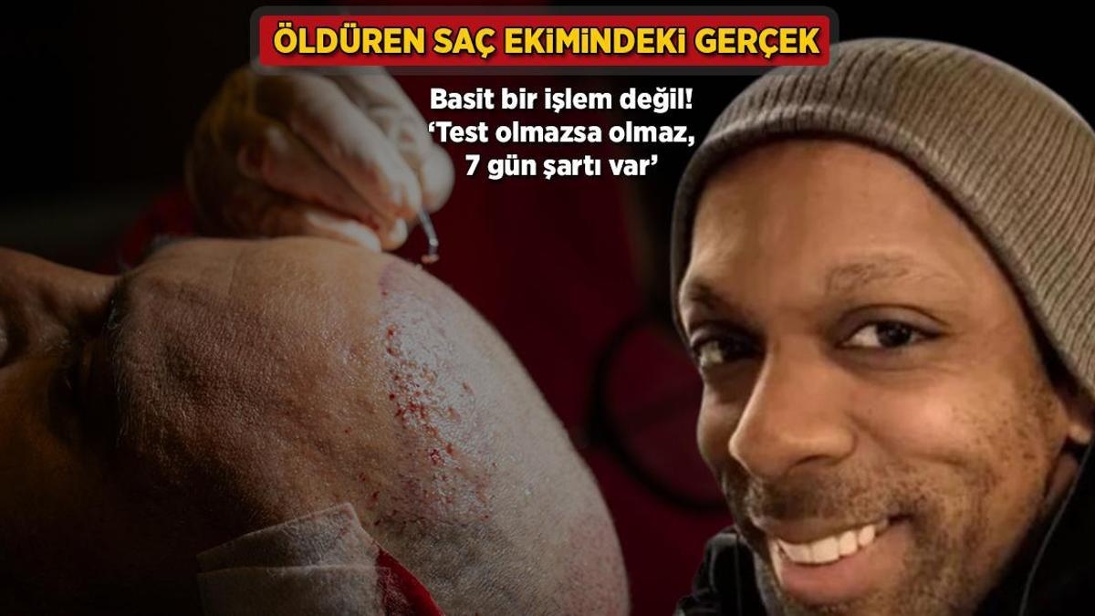 Öldüren saç ekimindeki gerçek! Basit bir işlem değil: 'Test olmazsa olmaz, 7 gün şartı var'