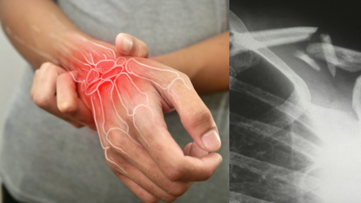 Giornata mondiale dell'osteoporosi: una malattia silenziosa che compromette la qualità della vita