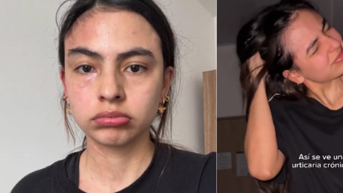 Michell Orozco, atriz de 'A Dama das Rosas', não consegue dormir há três meses devido a uma crise de urticária crônica: 'Tem sido horrível'