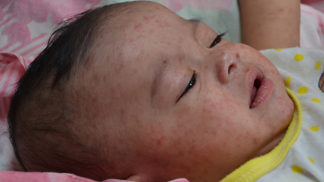 Measles epidemic: 658 cases recorded in 2025, a figure already well above that of 2024