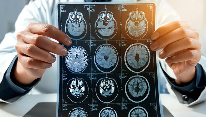 Harvard’dan çarpıcı yeni araştırma: Alzheimer tedavisine karşı yeni umut! Uzmanlar: "Bu büyük bir dönüm noktası olabilir"