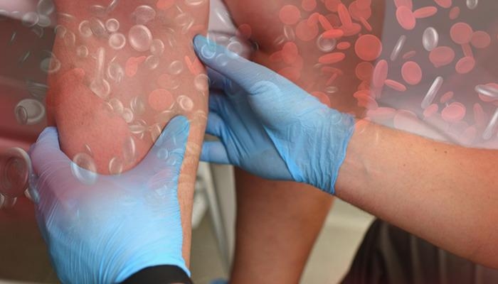 The most insidious and deadly disease of the modern age: 30 thousand people die from thrombosis every year in Türkiye!