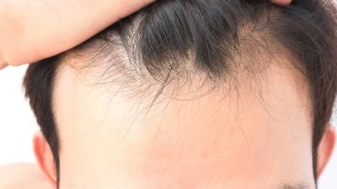 La causa nascosta della caduta dei capelli: quanto è efficace la carenza di vitamine e minerali?
