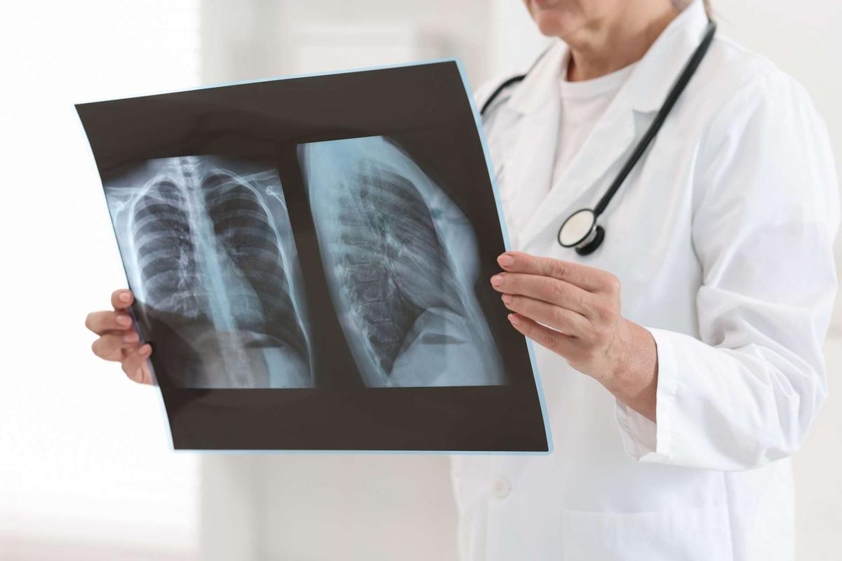 Adenocarcinoma de pulmón: la supervivencia a los 3 años se ha duplicado desde el año 2000