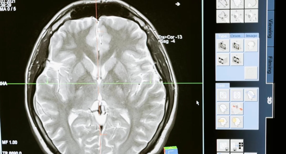 ¿La menstruación afecta al cerebro? Los científicos revelan cambios estructurales sorprendentes
