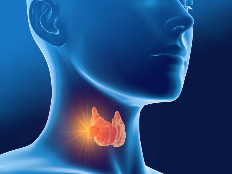 Thyroid cancer: First S3 guideline published