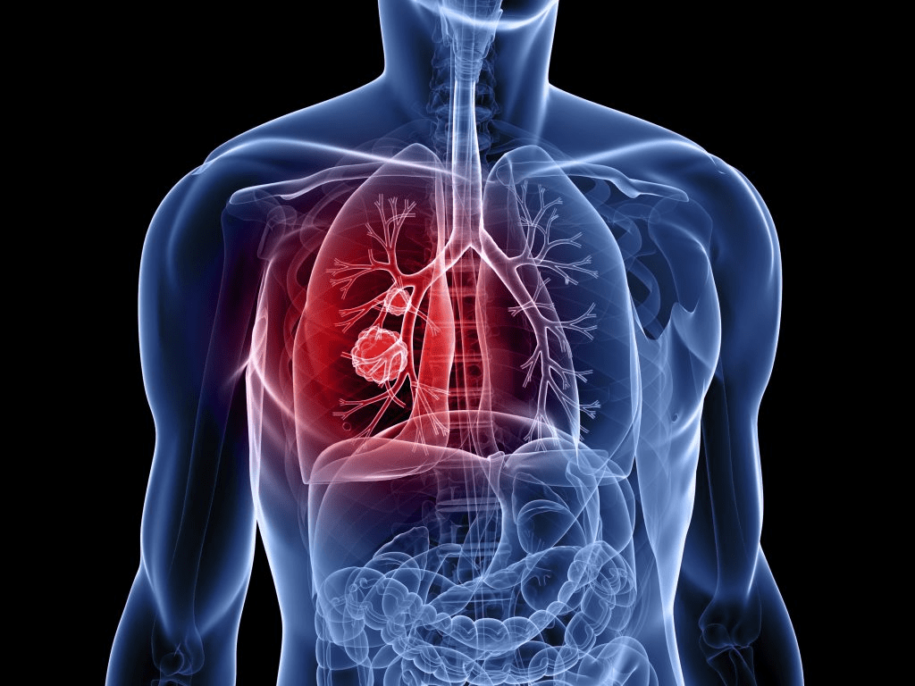 Programa en línea aumenta las tasas de detección del cáncer de pulmón