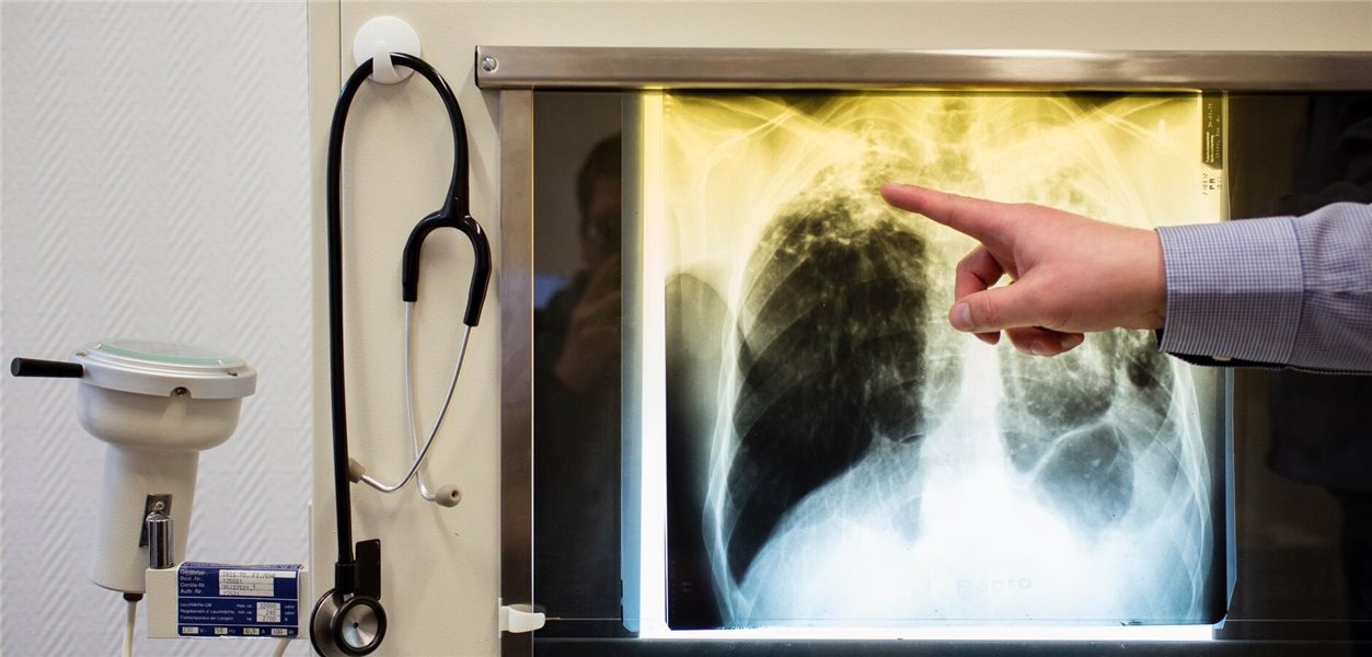 Slight decrease in tuberculosis cases
