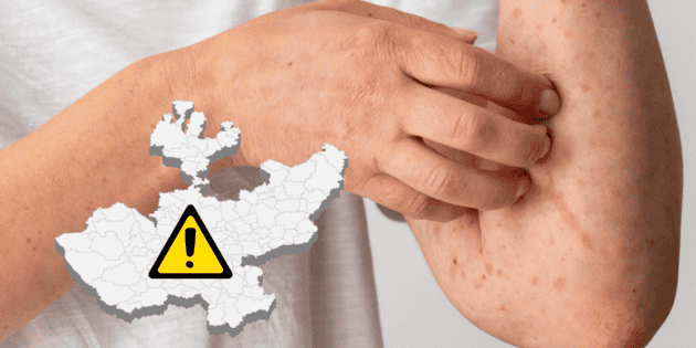 Das Gesundheitsamt von Jalisco bestätigt einen neuen Masernfall an einer privaten High School in Zapopan.